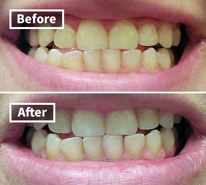 Close-up of teeth before and after whitening treatment showing a summer glow up transformation for a brighter smile.