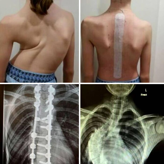 Images showing scoliosis correction with spinal surgery, including pre- and post-operation views and X-rays of medical hardware.