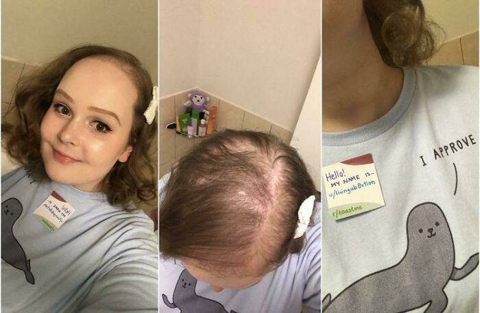 Young woman with hair loss wearing a seal shirt and a name tag, sharing her story to receive supportive internet toasts.