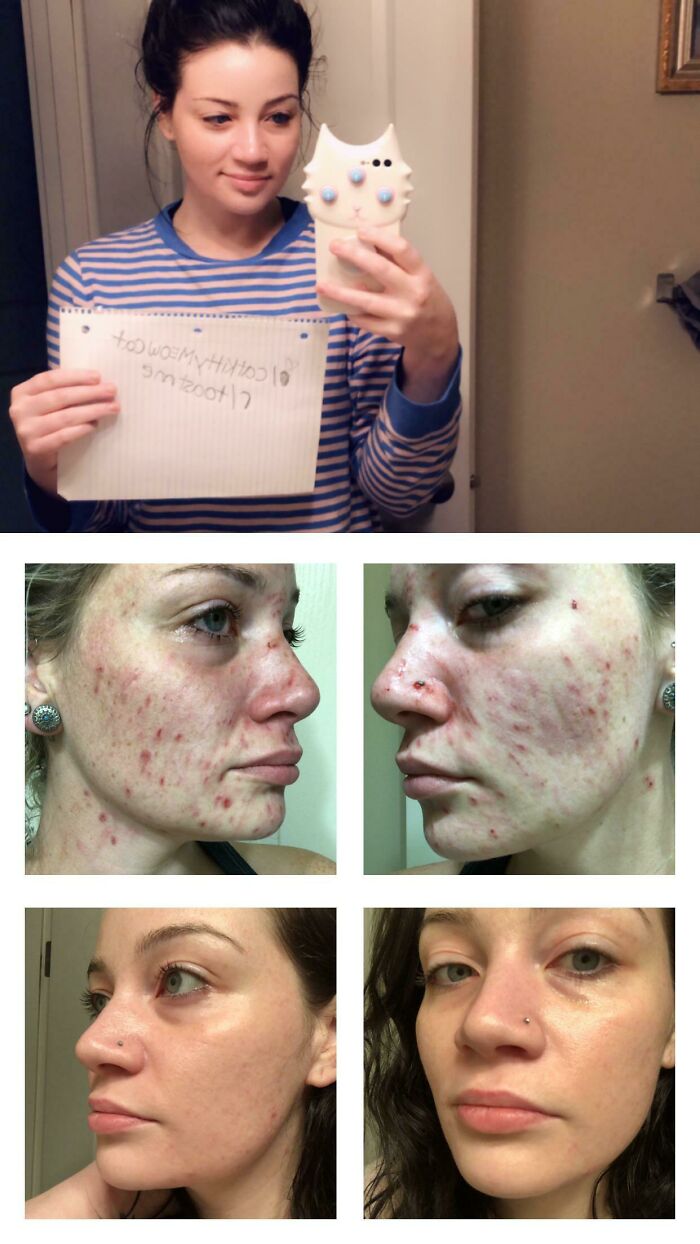 Collage showing a woman asking the internet to toast her and before-and-after acne skin transformation photos.