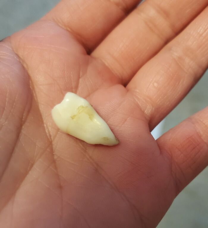 Close-up of a hand holding a tooth, illustrating one-in-a-million coincidences that are hard to believe.