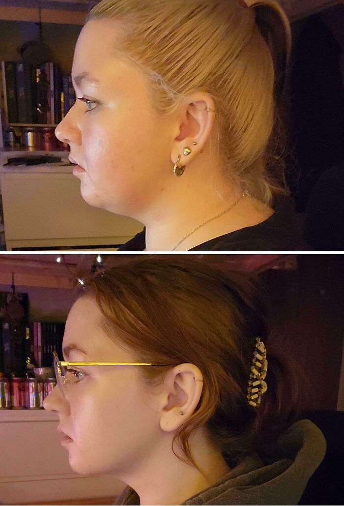 Side-by-side inspiring weight loss before and after pics showing facial transformation in profile view.