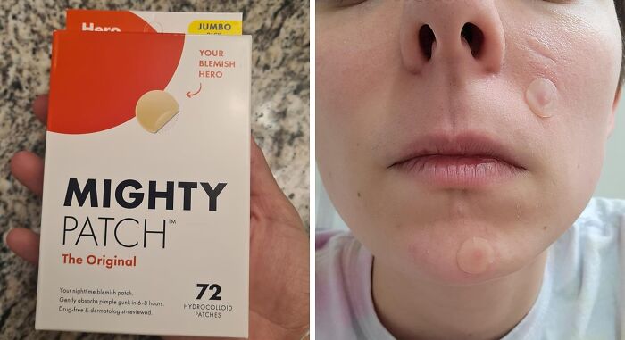 Hydrocolloid blemish patches shown in packaging and applied on face for viral summer essentials.