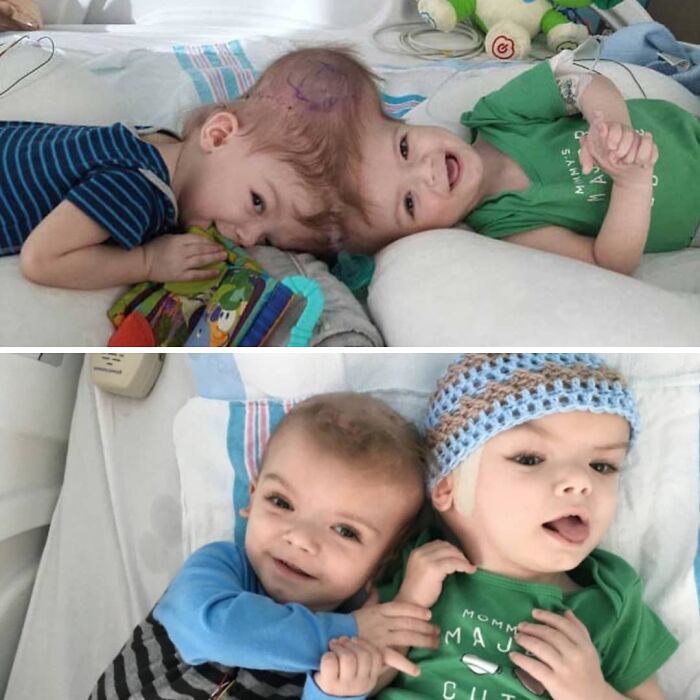 Bebés con condición médica especial en hospital, mostrando fotos médicas fascinantes e inquietantes de gemelos unidos.