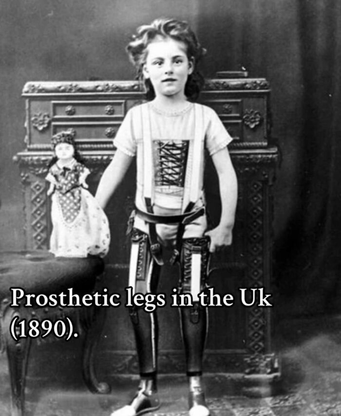 Young girl from 1890 UK wearing early prosthetic legs, a monumental life moment frozen in time.
