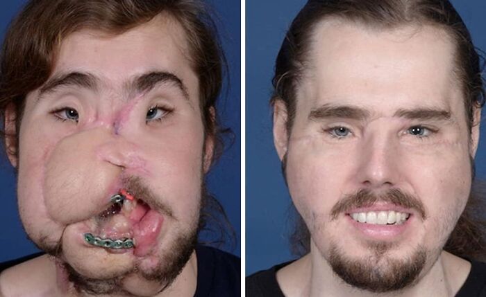 Hombre antes y después de cirugía reconstructiva facial, mostrando avances en fotos médicas fascinantes e inquietantes.
