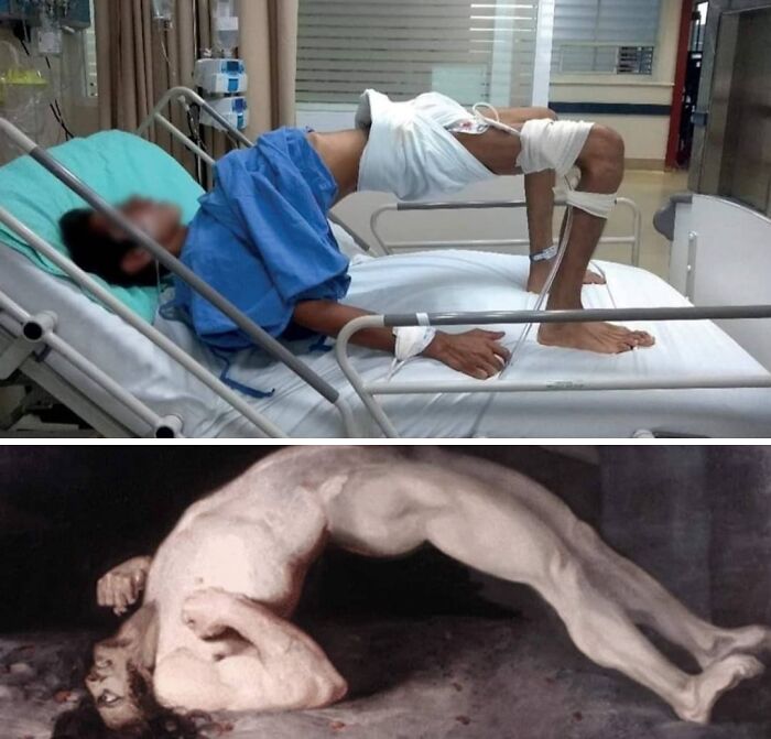 Patient in hospital bed demonstrating an uncanny medicine-related physical pose similar to a classical painting figure.