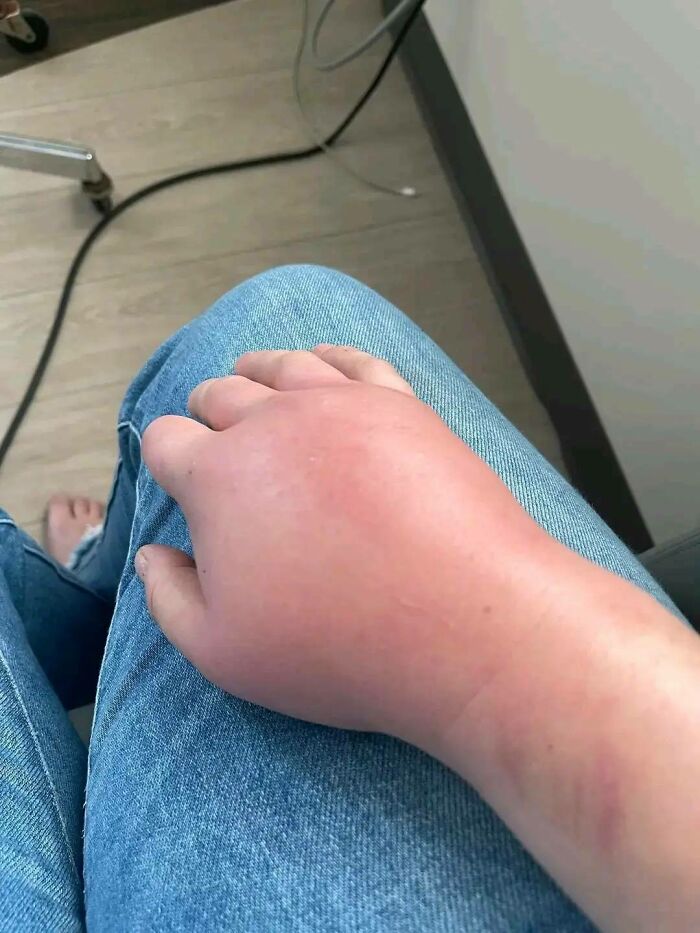 Mano inflamada sobre pierna con jeans mostrando una de las cosas que salieron mal y la gente compartió.