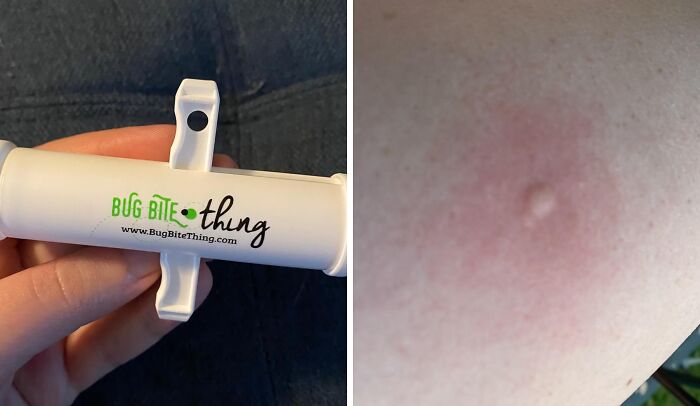Bug Bite Thing device held in hand next to a close-up of a red insect bite on skin from Shark Tank pitches.