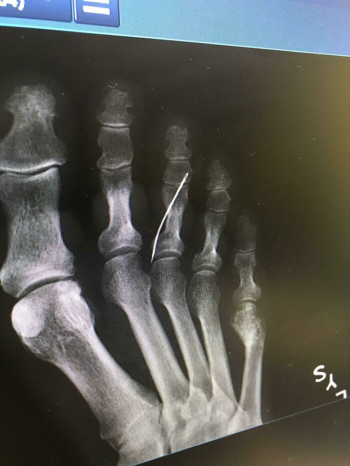 X-ray image of a human foot showing bones and a thin foreign object lodged between the toes, illustrating bizarre human body details.