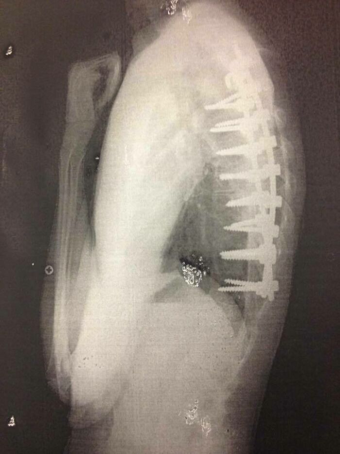 Radiografía de columna humana con tornillos metálicos mostrando una imagen interesante y curiosa del cuerpo humano.