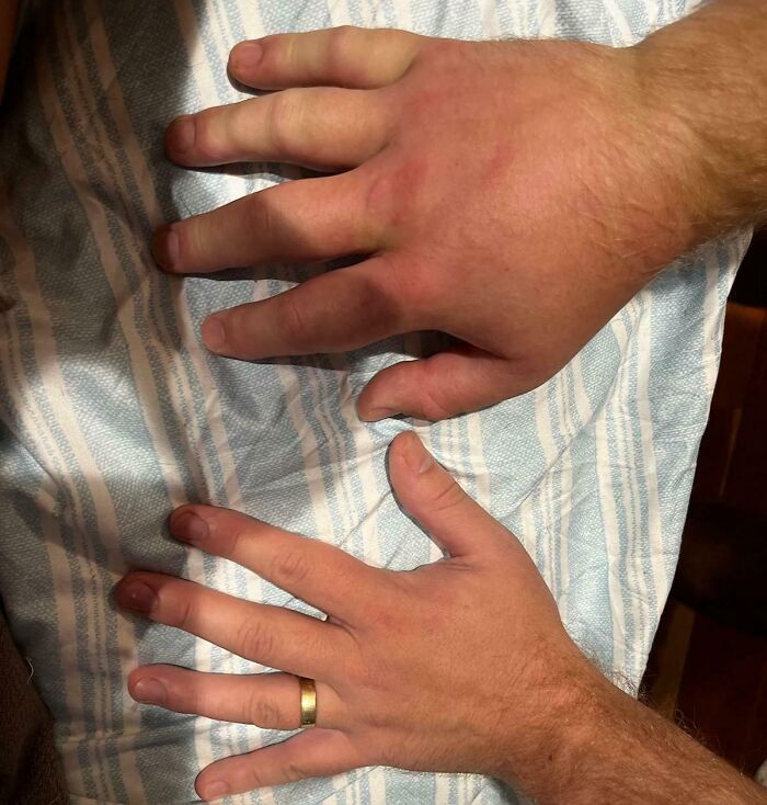 Close-up of swollen hand compared to normal hand on striped fabric, showcasing a fascinating picture for curious minds.