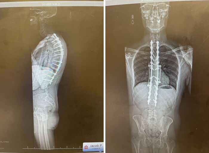 X-ray images of the human body showing spinal surgery with metal implants from side and front views.