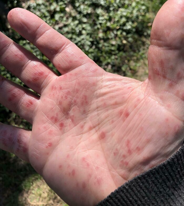Close-up of a human hand with red spots and skin irritation, showing a bizarre and fascinating condition of the human body.