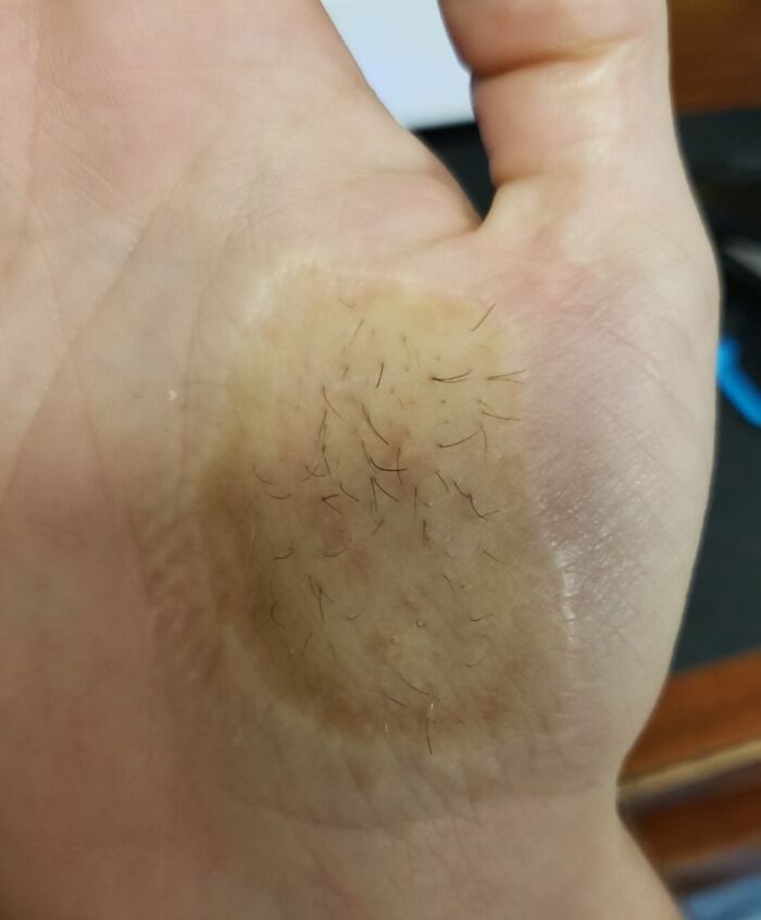Mano con marca en la piel que muestra un área con vello inusual, imagen curiosa del cuerpo humano.