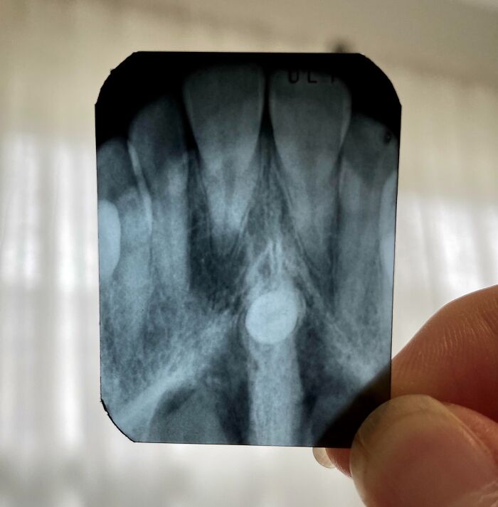 X-ray image of the human body showing intricate bone structure and a round object near the tooth roots.