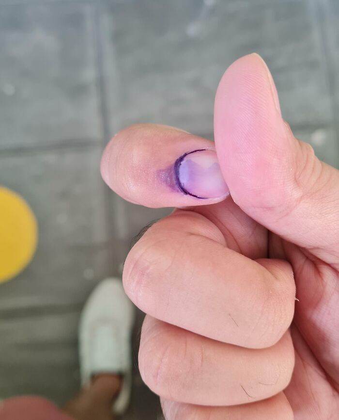 Close-up of a finger with a purple ink mark on the nail, showing a clever way people solved overlooked issues.