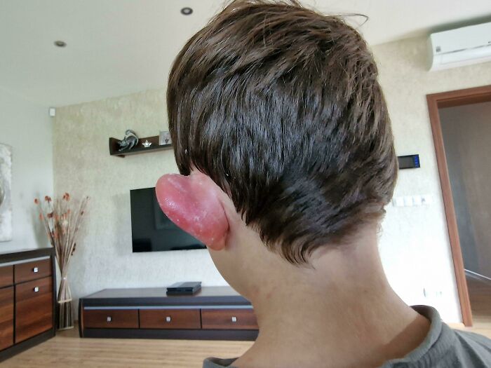 Padre con inflamación severa en la oreja, mostrando un día difícil y situaciones complicadas de padres y madres.