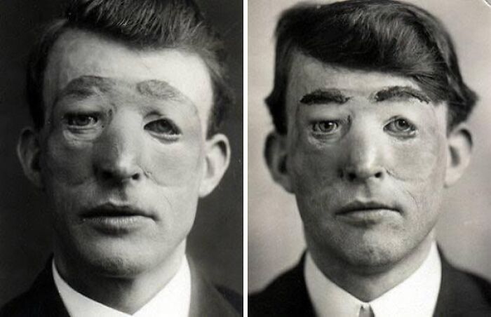 Black and white photos of a man with a reconstructed face showing unusual and tragic things that actually happened.