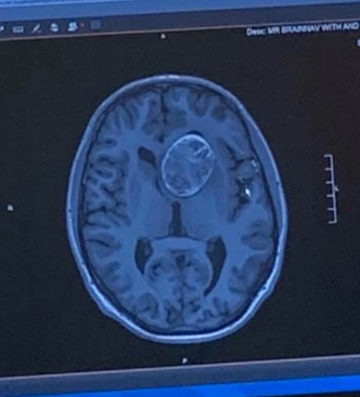 Imagen de resonancia magnética cerebral mostrando detalles interesantes y curiosos del cuerpo humano en sección transversal.