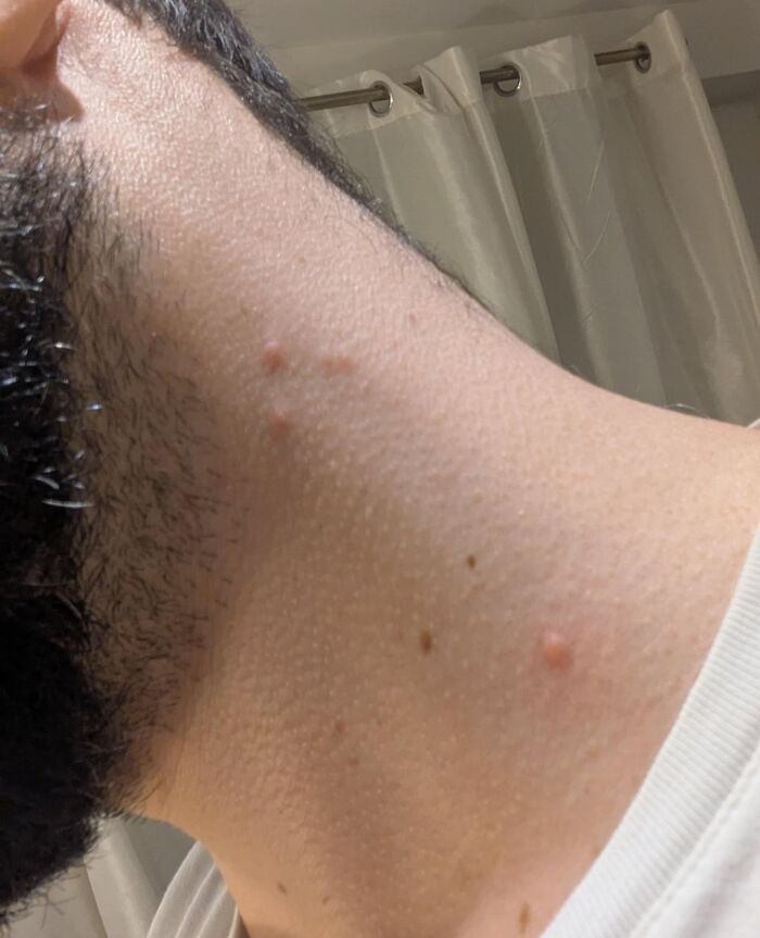 Close-up of a man's neck with red bumps and irritated skin, illustrating a Friday the 13th bad day scenario.