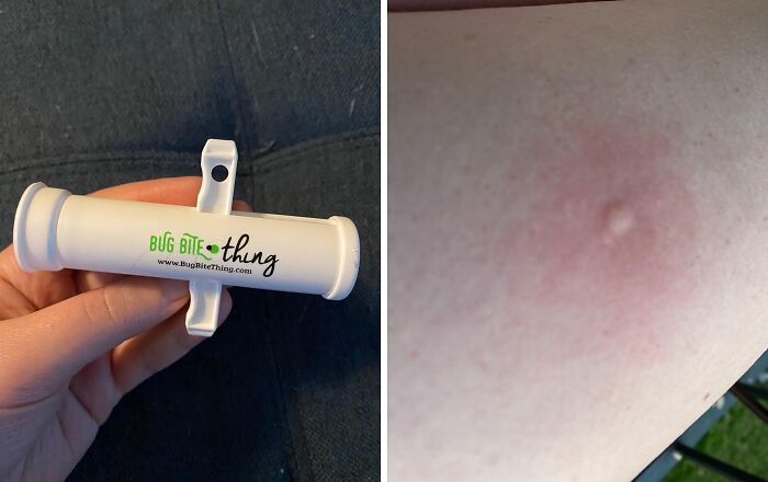 Hand holding a bug bite relief tool beside a close-up of a red, irritated bug bite on skin for picnic day essentials.