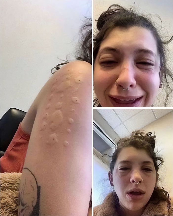 Primer plano de piel con bultos visibles y rostro con inflamación y malestar, fotos médicas que muestran lo aterrador del cuerpo.