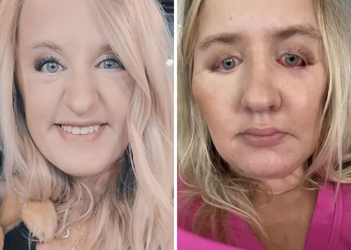 Before and after photos of a woman showing results of plastic surgery that reportedly disfigured her face.