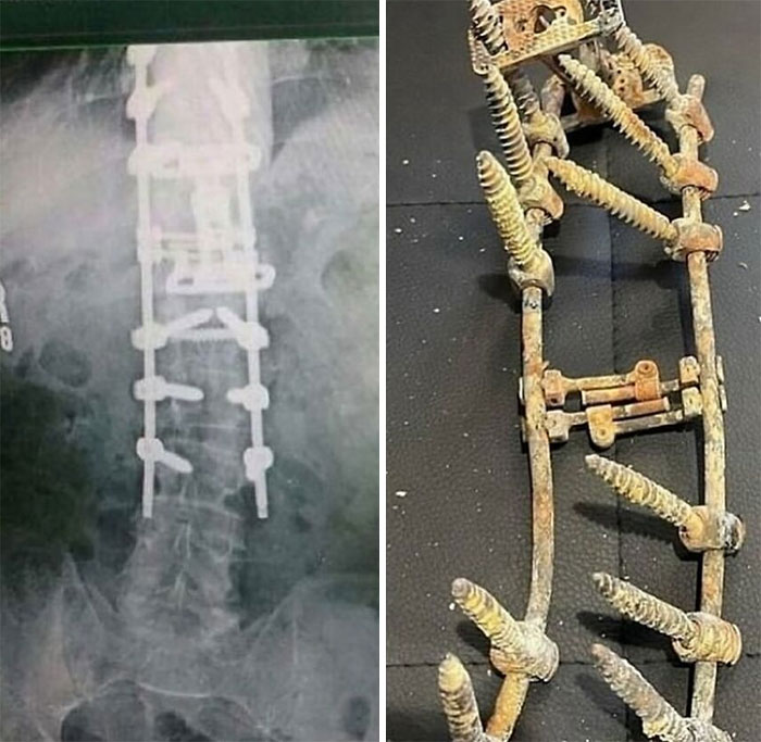 Radiografía y dispositivo médico antiguo con tornillos grandes que muestran fotos médicas impactantes del cuerpo humano.