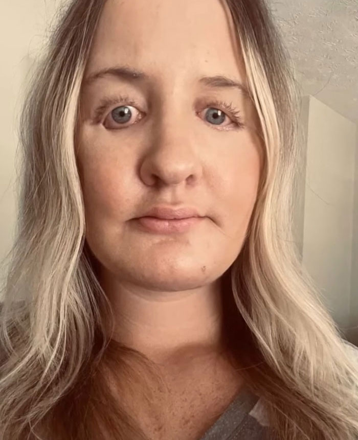 Close-up portrait of a woman showing facial changes after a plastic surgery procedure gone wrong.