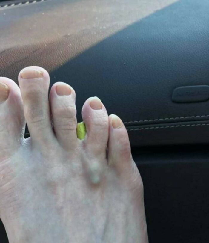 Pie de pie con dedo con deformidad y una protuberancia, imagen médica fascinante y inquietante.