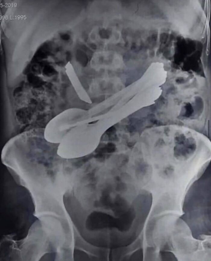 X-ray showing uncanny medical case with foreign objects including spoons inside the abdominal cavity, highlighting moments medicine crosses the uncanny.