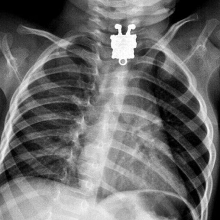 X-ray image showing an uncanny medical object lodged in the chest near the ribcage and spine.