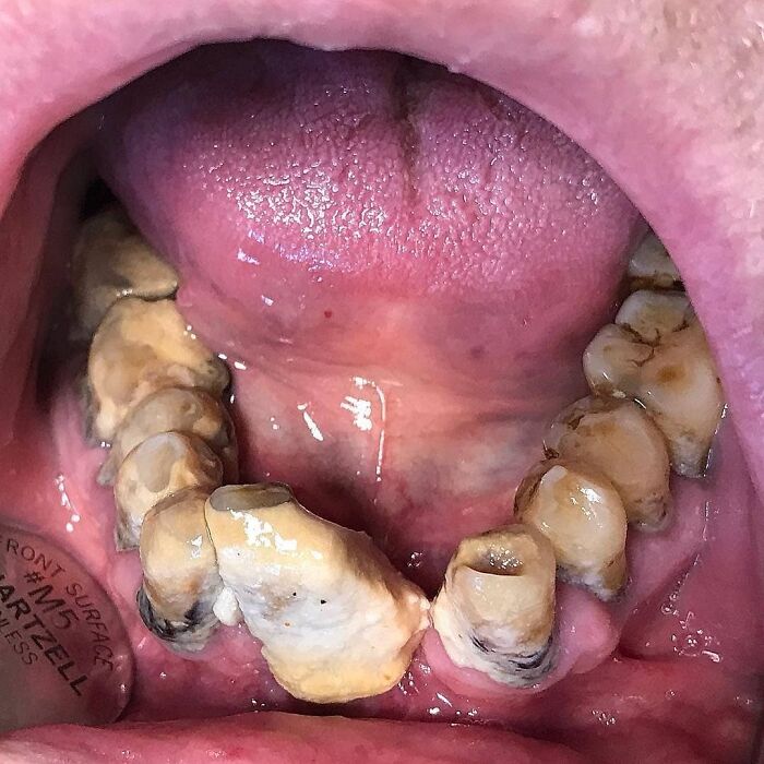 Severe tooth decay and damage inside a human mouth showing an uncanny moment in medicine and oral health.