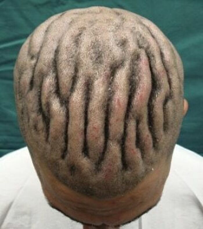 Close-up of a scalp showing an uncanny skin condition resembling deep grooves, highlighting unusual medicine cases.