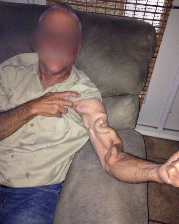 Man with an unusually twisted and bent arm sitting on a couch, illustrating moments when medicine crossed into the uncanny.