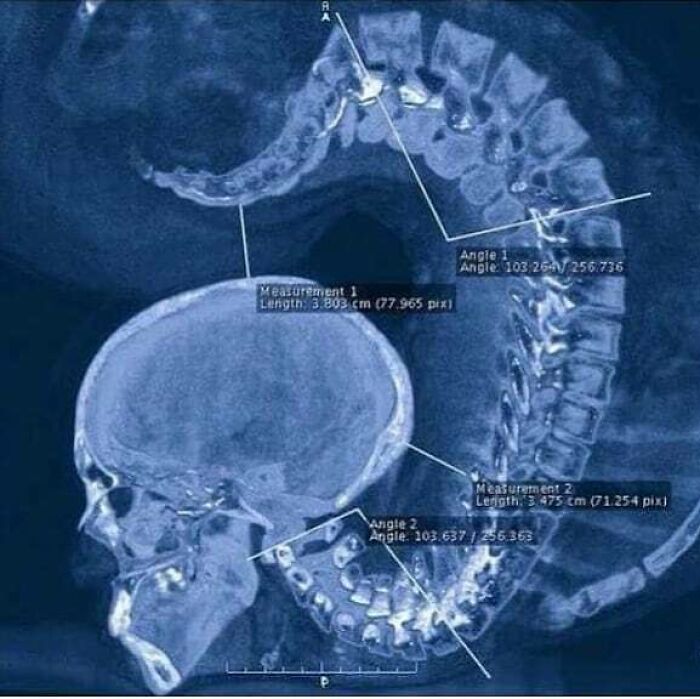 X-ray image of a human skull with elongated spine and detailed measurements showing uncanny medical anomalies.
