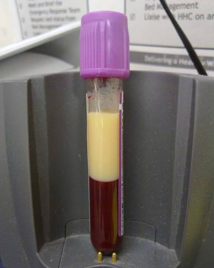 Blood sample with abnormal milky plasma layer, illustrating uncanny moments in medicine and unusual medical phenomena.