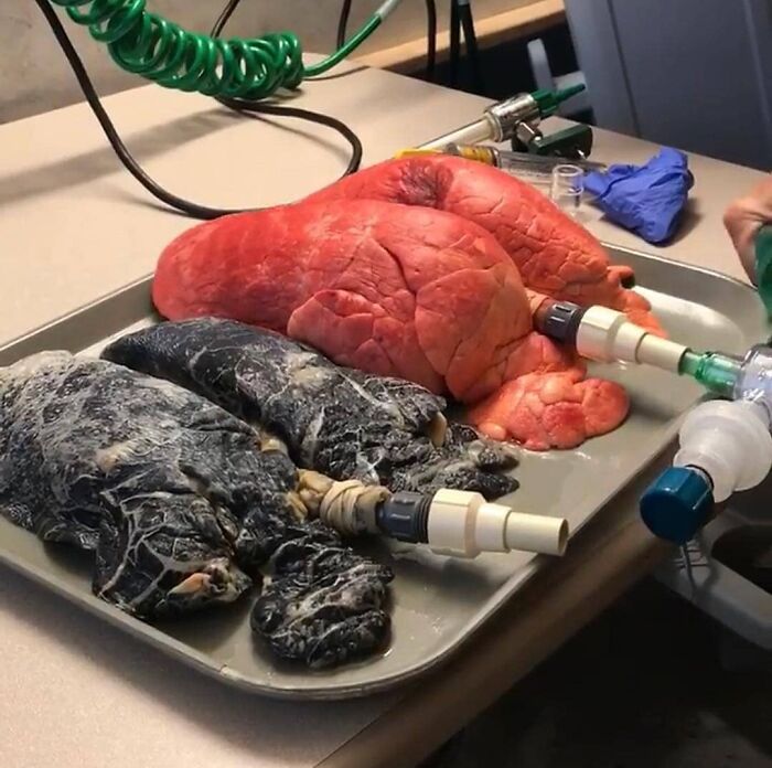 Pulmones humanos sanos y dañados por fumar, mostrados en una foto médica fascinante e inquietante.