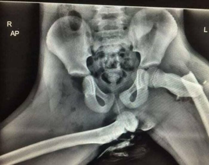 X-ray image showing a fractured pelvis and broken femur, illustrating moments when medicine crossed into the uncanny.