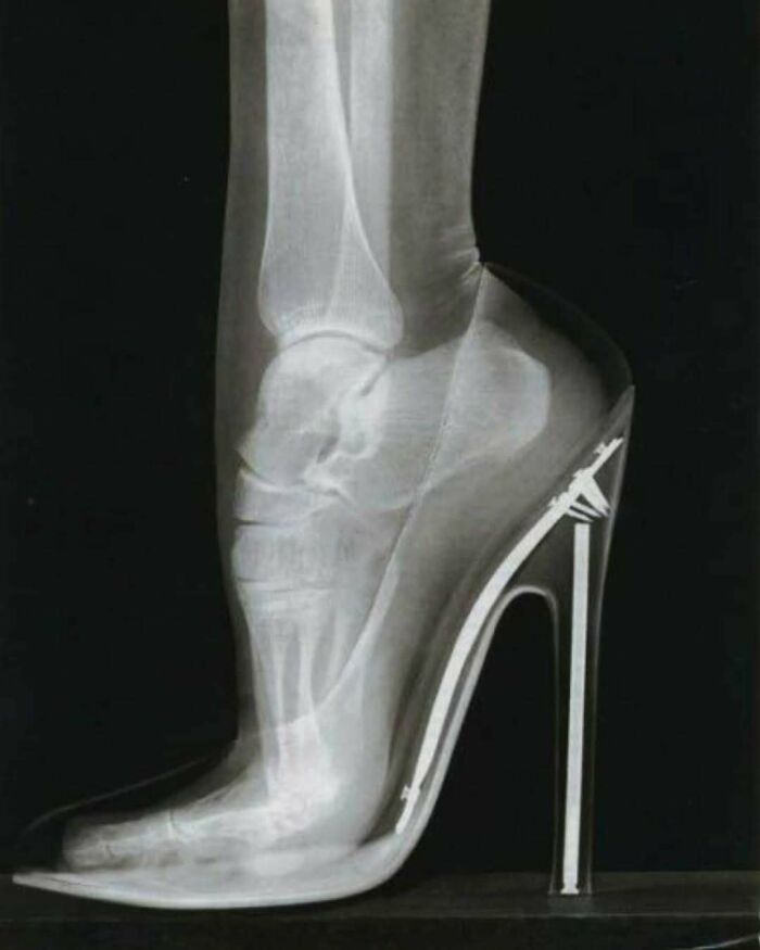 X-ray image showing foot bones inside a high-heeled shoe, illustrating moments when medicine crossed into the uncanny.