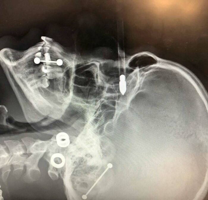 X-ray of skull with various metal implants and screws, illustrating uncanny moments in medicine involving unusual medical imagery.