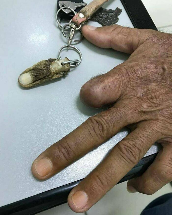 Severed human finger keychain beside a hand missing a finger, illustrating uncanny moments in medicine.