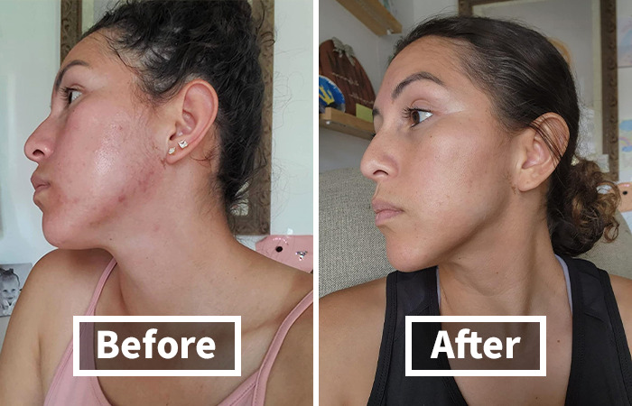 Side-by-side before and after photos showing beauty MVPs effectively tackling awkward skin issues on a woman's face.