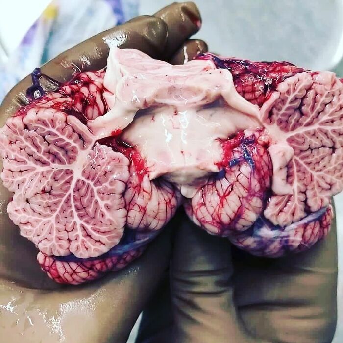 Close-up of gloved hands holding a detailed human brain cross-section showing intricate blood vessels in a medical setting.