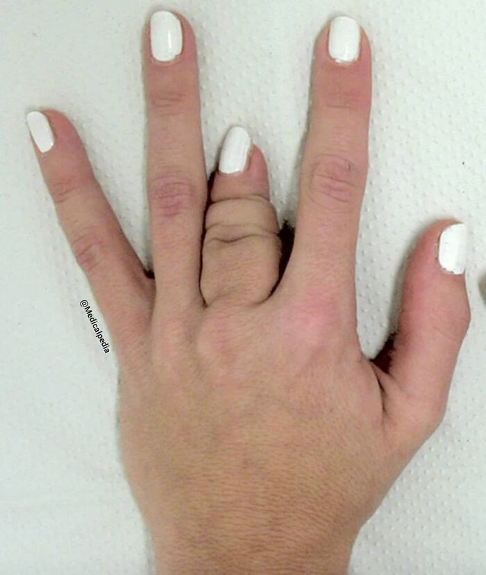 Human hand with an uncanny extra finger appearing between the middle and ring fingers, highlighting medicine oddities.