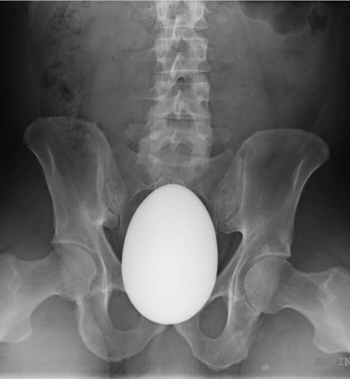 X-ray image showing an unusual object resembling an egg inside the pelvic area, highlighting uncanny moments in medicine.