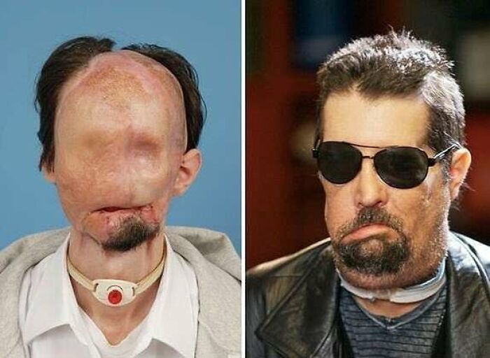 Before and after images of a man undergoing a medical procedure that crosses into the uncanny realm of medicine.