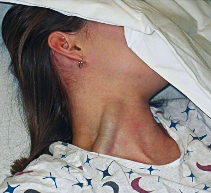 Paciente en cama con cuello inflamado, imagen médica fascinante mostrando signos visibles de posible problema médico.