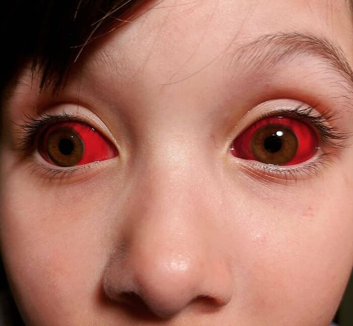 Close-up of a person's eyes with unnaturally red sclera, illustrating uncanny moments in medicine.